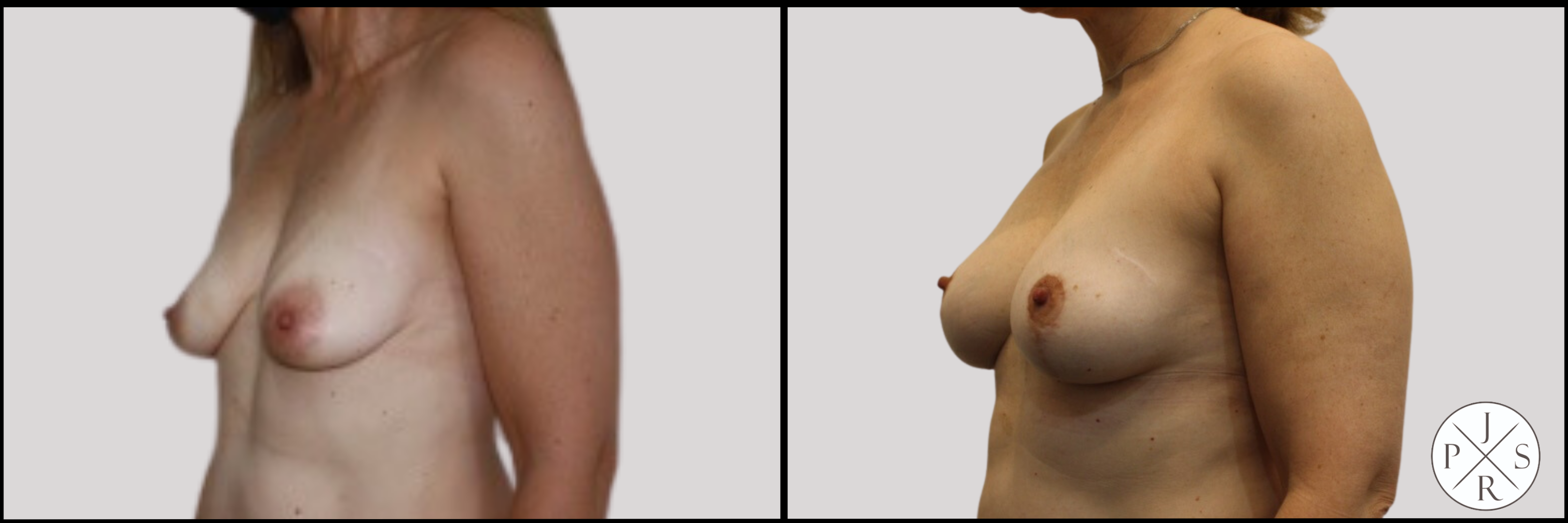 Fat Transfer Breast Augmentation Before & After Image